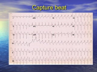 Arrhythmia: ECG--- Tachycardia_20120902_北區 | PPT