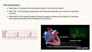 Tachyarrhythmia Lecture. Doctor/ Jane Nader | PPTX
