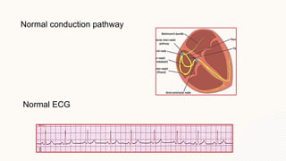 Normal Electrical Pathways Tachyarrhythmia Lecture. Doctor/ Jane Nader | PPTX