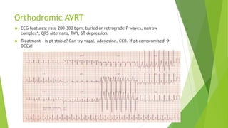 Orthodromic AVRT 
 ECG features: rate 200-300 bpm; buried or retrograde P waves, narrow 
complex*, QRS alternans, TWI, ST depression. 
 Treatment – is pt stable? Can try vagal, adenosine, CCB. If pt compromised  
DCCV! 
 