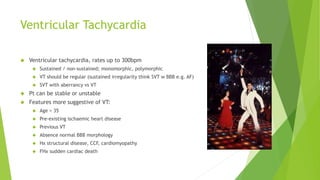 Ventricular Tachycardia 
 Ventricular tachycardia, rates up to 300bpm 
 Sustained / non-sustained; monomorphic, polymorphic 
 VT should be regular (sustained irregularity think SVT w BBB e.g. AF) 
 SVT with aberrancy vs VT 
 Pt can be stable or unstable 
 Features more suggestive of VT: 
 Age > 35 
 Pre-existing ischaemic heart disease 
 Previous VT 
 Absence normal BBB morphology 
 Hx structural disease, CCF, cardiomyopathy 
 FHx sudden cardiac death 
 