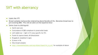 SVT with aberrancy 
 Looks like VT! 
 Broad complex tachycardia originating above Bundle of His. Becomes broad due to 
pre-existing BBB. This will be seen on the baseline ECG! 
 Some clues to distinguish 
 North west axis 
 Concordance of QRS complexes in praecordial leads 
 Left rabbit ear > right in V1 (very specific for VT) 
 Fusion & capture beats; AV dissociation 
 Brugada & Josephson’s signs 
 Q wave in V6 
 Very broad complex 
 http://lifeinthefastlane.com/ecg-library/basics/vt_vs_svt/ for examples of above 
 