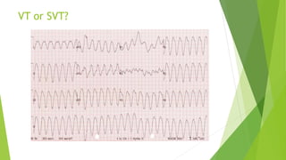 VT or SVT? 
 