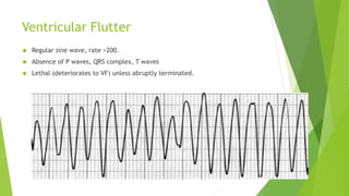 Ventricular Flutter 
 Regular sine wave, rate >200. 
 Absence of P waves, QRS complex, T waves 
 Lethal (deteriorates to VF) unless abruptly terminated. 
 