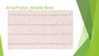 Atrial Flutter, Variable Block 
 