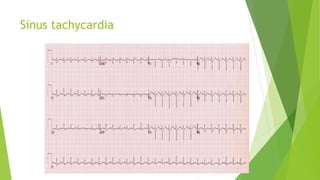 Sinus tachycardia 
 