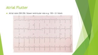 Atrial Flutter 
 Atrial rates 250-350. Slower ventricular rate e.g. 150 = 2:1 block 
 