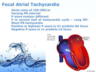 Page 19
Focal Atrial Tachycardia
Atrial rates of 150-200/m
Varying PR intervel
P wave contour different
P in second half of tachycardia cycle – Long RP-
Short PR tachycardia
Positive or biphasic P wave in V1 predicts RA focus
Negative P wave in v1 predicts LA foucs
 
