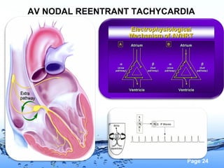 Page 24
AV NODAL REENTRANT TACHYCARDIA
 