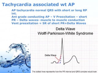 Page 32
Tachycardia associated wt AP
AP tachycardia normal QRS with short or long RP
int.
Ant grade conducting AP – V Preexitation – short
PR – Delta waves- muscle to muscle conduction
Vent preexitation = SR of short PR+Delta Waves
 