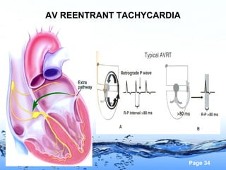 Page 34
AV REENTRANT TACHYCARDIA
 