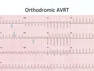 Page 44
Orthodromic AVRT
 