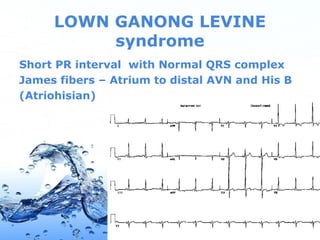 Page 45
LOWN GANONG LEVINE
syndrome
Short PR interval with Normal QRS complex
James fibers – Atrium to distal AVN and His B
(Atriohisian)
 