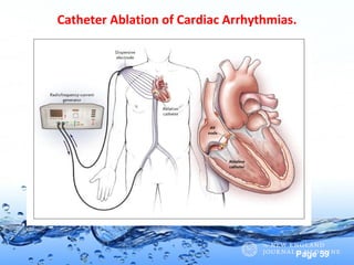 Page 59
Catheter Ablation of Cardiac Arrhythmias.
 