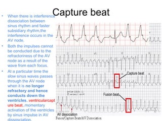 Capture beat• When there is interference
dissociation between
sinus rhythm and faster
subsidiary rhythm,the
interference occurs in the
AV node.
• Both the impulses cannot
be conducted due to the
refractoriness of the AV
node as a result of the
wave from each focus.
• At a particular time the
slow sinus waves passes
through the AV node
when it is no longer
refractory and hence
conducts down the
ventricles..ventricularcapt
ure beat..momentary
activation of the ventricles
by sinus impulse in AV
 