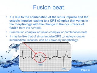 Page 66
Fusion beat
• It is due to the combination of the sinus impulse and the
ectopic impulse leading to a QRS c0mplex that varies in
the morphology with the change in the occurrence of
fusion from the AVnode.
• Summation complex or fusion complex or combination beat
• It may be like that of sinus impulseQRS ,or ectopic one,or
intermediate..location can be known by morphology.
 