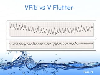 Page 78
VFib vs V Flutter
 