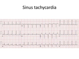 Sinus tachycardia
 