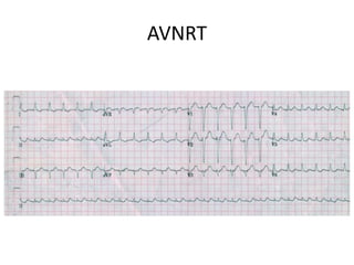 AVNRT
 