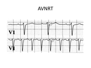 AVNRT
 