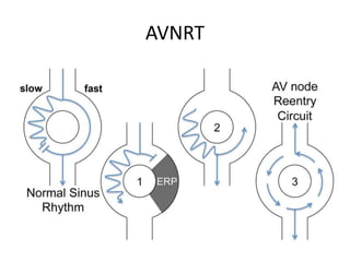 AVNRT
 