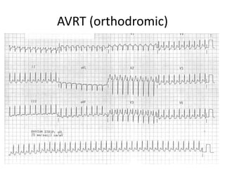 AVRT (orthodromic)
 