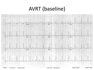 AVRT (baseline)
 