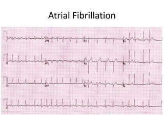 Atrial Fibrillation
 