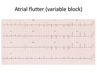 Atrial flutter (variable block)
 