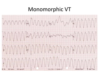 Monomorphic VT
 
