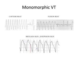 Monomorphic VT
 