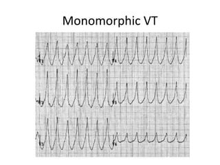 Monomorphic VT
 
