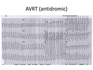 AVRT (antidromic)
 