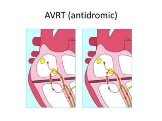AVRT (antidromic)
 