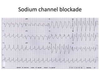 Sodium channel blockade
 