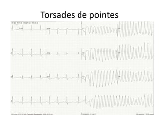 Torsades de pointes
 
