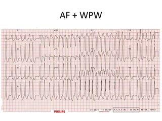 AF + WPW
 