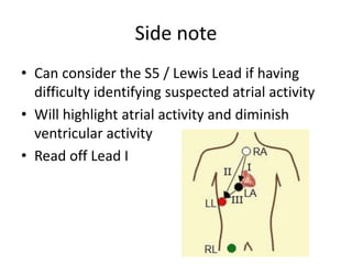 Side note
• Can consider the S5 / Lewis Lead if having
difficulty identifying suspected atrial activity
• Will highlight atrial activity and diminish
ventricular activity
• Read off Lead I
 