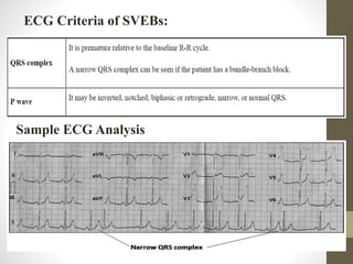 ECG Criteria of SVEBs:
Sample ECG Analysis
 