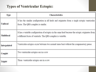 Types of Ventricular Ectopic:
 