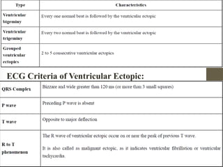 ECG Criteria of Ventricular Ectopic:
 