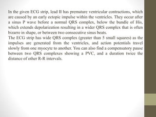 In the given ECG strip, lead II has premature ventricular contractions, which
are caused by an early ectopic impulse within the ventricles. They occur after
a sinus P wave before a normal QRS complex, below the bundle of His,
which extends depolarization resulting in a wider QRS complex that is often
bizarre in shape, or between two consecutive sinus beats.
The ECG strip has wide QRS complex (greater than 5 small squares) as the
impulses are generated from the ventricles, and action potentials travel
slowly from one myocyte to another. You can also find a compensatory pause
between two QRS complexes showing a PVC, and a duration twice the
distance of other R-R intervals.
 