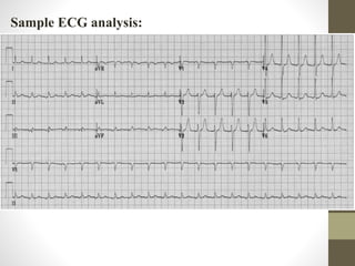 Sample ECG analysis:
 