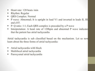  Heart rate: 120 beats /min
 Rhythm: Regular
 QRS Complex: Normal
 P wave: Abnormal; It is upright in lead V1 and inverted in leads II, III,
and aVF.
 P: Q ratio: 1:1; Each QRS complex is preceded by a P wave
 Interpretation: A heart rate of 120bpm and abnormal P wave indicates
that the patient has atrial tachycardia
Atrial tachycardia is sub classified based on the mechanism. Let us now
learn about the three forms of atrial tachycardia:
 Atrial tachycardia with block
 Multifocal atrial tachycardia
 Paroxysmal atrial tachycardia
 
