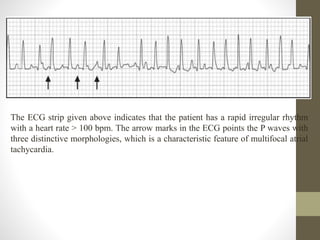 The ECG strip given above indicates that the patient has a rapid irregular rhythm
with a heart rate > 100 bpm. The arrow marks in the ECG points the P waves with
three distinctive morphologies, which is a characteristic feature of multifocal atrial
tachycardia.
 