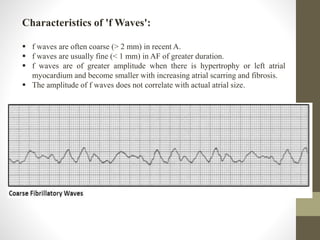 Characteristics of 'f Waves':
 f waves are often coarse (> 2 mm) in recent A.
 f waves are usually fine (< 1 mm) in AF of greater duration.
 f waves are of greater amplitude when there is hypertrophy or left atrial
myocardium and become smaller with increasing atrial scarring and fibrosis.
 The amplitude of f waves does not correlate with actual atrial size.
 