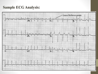 Sample ECG Analysis:
 