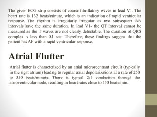 The given ECG strip consists of coarse fibrillatory waves in lead V1. The
heart rate is 132 beats/minute, which is an indication of rapid ventricular
response. The rhythm is irregularly irregular as two subsequent RR
intervals have the same duration. In lead V1- the QT interval cannot be
measured as the T waves are not clearly detectable. The duration of QRS
complex is less than 0.1 sec. Therefore, these findings suggest that the
patient has AF with a rapid ventricular response.
Atrial Flutter
Atrial flutter is characterized by an atrial microreentrant circuit (typically
in the right atrium) leading to regular atrial depolarizations at a rate of 250
to 350 beats/minute. There is typical 2:1 conduction through the
atrioventricular node, resulting in heart rates close to 150 beats/min.
 