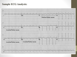 Sample ECG Analysis:
 