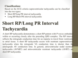 Classification:
Based on the ECG criteria supraventricular tachycardia can be classified
into the two types:
 Short RP/long PR interval tachycardia
 Long RP/Short PR interval tachycardia
Short RP/Long PR Interval
Tachycardia
A short RP tachycardia demonstrates a short RP pattern with P waves embedded
within or occurring closely after the preceding QRS complex. The RP interval
reflects the retrograde conduction time for an impulse to travel from ventricular
to atrial tissue. A short RP tachycardia occurs with reentrant supraventricular
tachycardia when the retrograde VA conduction time is shorter than the
anterograde AV conduction time. In general, atrioventricular nodal reentrant
tachycardia (AVNRT) and atrioventricular reentrant tachycardia (AVRT) are
short RP tachycardia.
 